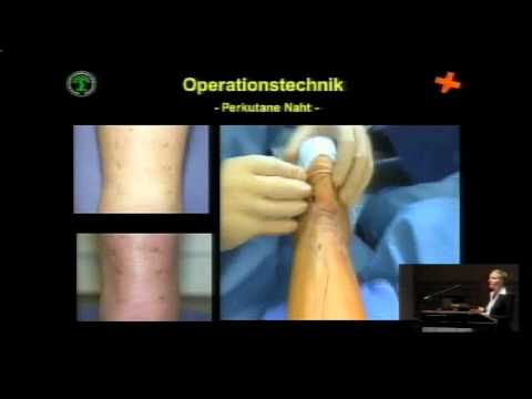 Rotations Schultergelenk Anatomie 4 ds wunden unteren Rücken