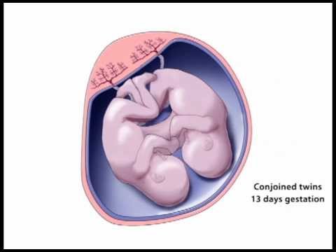 Conjoined Twins