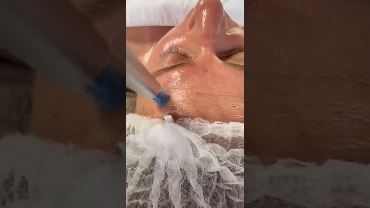 Microneedling with Exosomes & Salmon DNA | La Lueur Spa Burlington MA