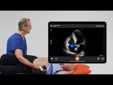 Color Doppler for Tricuspid Regurgitation