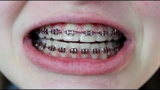 how to get rid of braces pain instantly