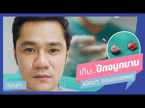 โบท็อก ปีกจมูก