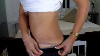 Risultato Chirurgia Plastica dopo 4 mesi - Cicatrici