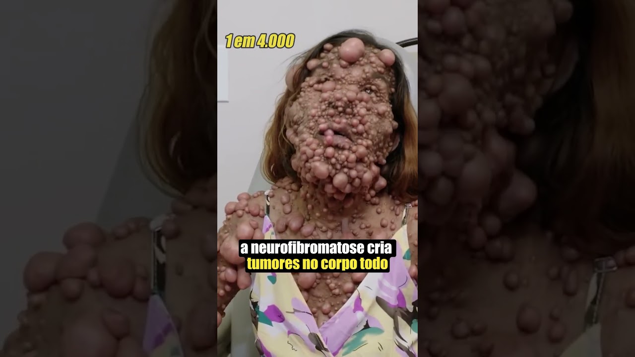 As Mutações Humanas Mais Raras 😯