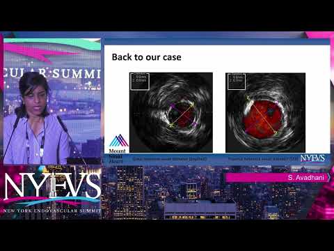 Intravascular Ultrasound  Update of Current Data and Tips on How to Use IVUS - Dr. Sriya Avadhani