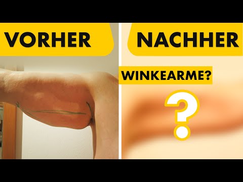 Oberarmstraffung Vorher & Nachher! | 62-jährige Patientin | Dr. Jungwirth