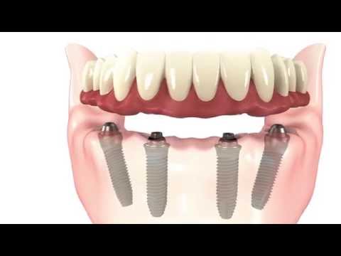 All-on-4 Dental Implants Simple Procedure Animation