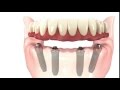 All-on-4 Dental Implants Simple Procedure Animation