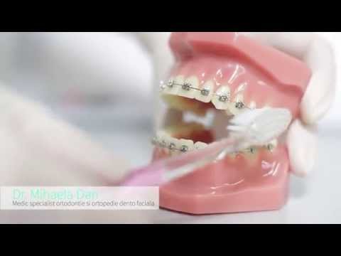 download lagu mp3 mp4 Aparat Ortodontic, download lagu Aparat Ortodontic gratis, unduh video klip Aparat Ortodontic