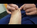 Surgical correction of an elevated fifth toe - Digiti Quinti Varus