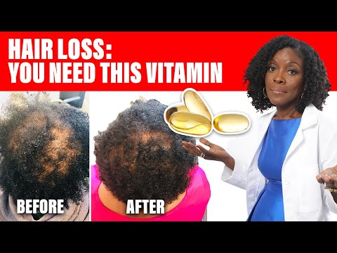 Hair Loss: This Vitamin Can Save Your Hair