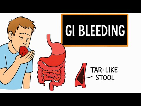 Gastrointestinal Bleeding: Upper vs Lower GI Bleed Overview