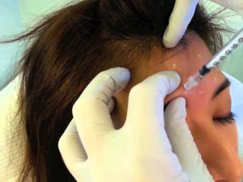 Botulinum Toxin Injection