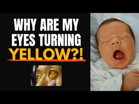 What is Jaundice? Symptoms, Causes, Treatment & Types Explained | Newborn & Adult Jaundice