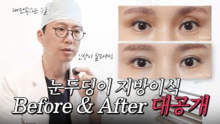 눈두덩이 지방이식 전후! 드라마틱 변화 리뷰 공개! ✨ [JPN]