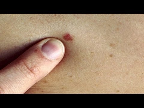 Lentiggine e hokha Se ci sono posti di pigmentary bianchi