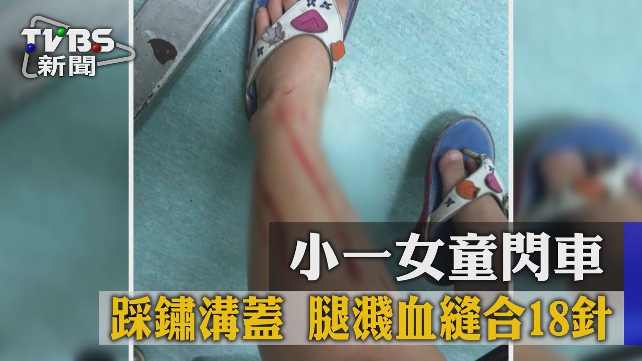 工程做一半…女童踩破鏽蝕水孔蓋縫18針