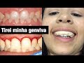 GENGIVOPLASTIA Cirurgia Que Tirei Minha Gengiva