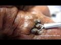 Gold Mine Of Black Heads On Nose