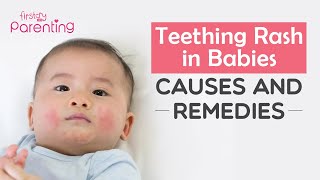 Teething Rash (Drool Rash) in Babies - Causes, Remedies & Prevention