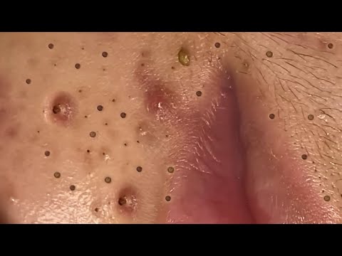 Blackhead removal Video #58 #Blackheads #blackheadsremoval #sebum