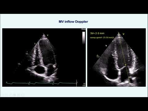 Diastolic Dysfunction part I