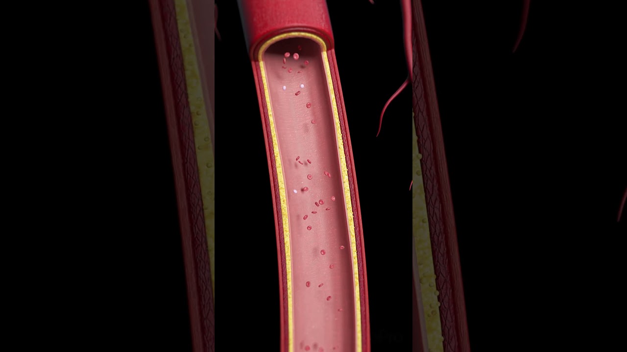 Atherosclerosis: The Silent Build-Up