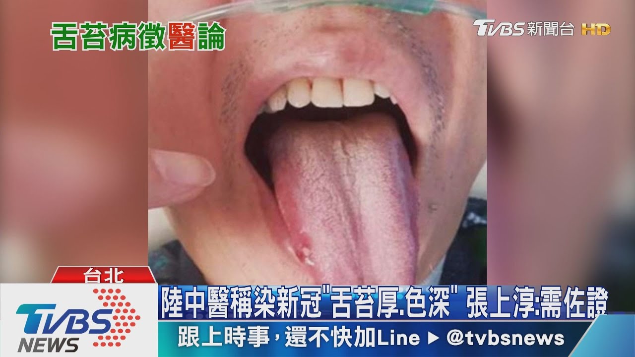 陸中醫稱染新冠「舌苔厚、色深」 張上淳:需佐證