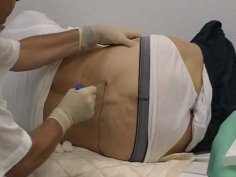 Behandlung von Dehnungs Ellbogen Ligamentum Tinktur von Löwenzahn für die Gelenke, wie man kocht