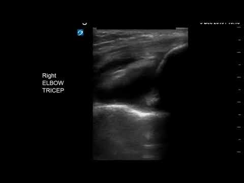 Elbow Ultrasound: Joint Effusion (Long Axis)