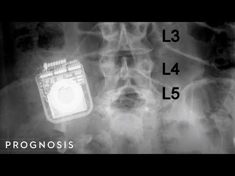 A Promising Paralysis Treatment Discovered by Chance...