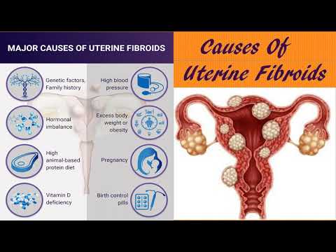 Uterine Fibroid Homeopathy Treatment Chennai
