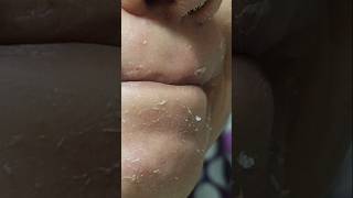 almost the 10th month of Tretinoin || Dryness-peeling||but no more pimples