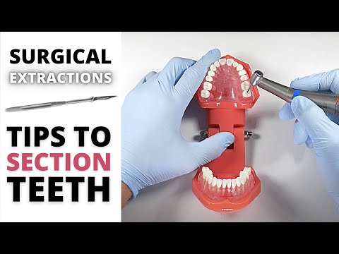 Surgical Extraction Sectioning Tips