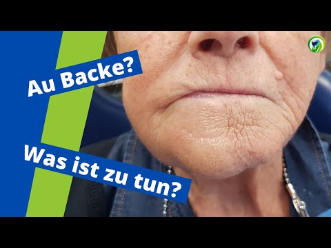 Dicke Backe, Schwellung, starke Schmerzen - Was ist zu tun? Abszess -  Patientenfall , Therapie