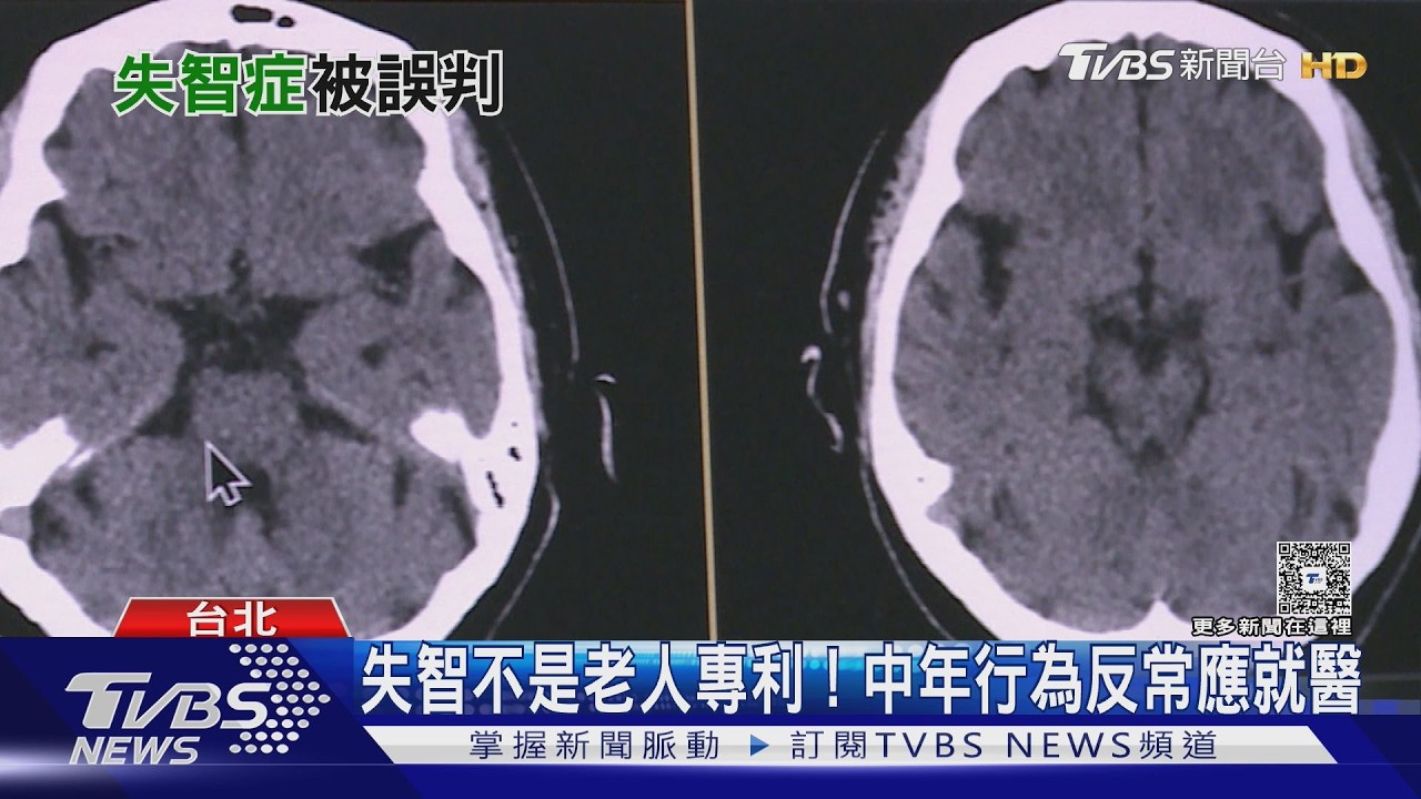 影音/額顳葉失智症不一定先健忘!個性突變、衝動失控及語言障礙要留意