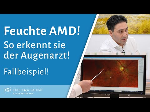 Wie erkennt der Augenarzt eine feuchte Makuladegeneration?