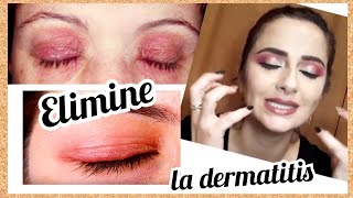 Dermatitis Atopica | Eczema | Cómo la eliminé por completó | Dannah Rey