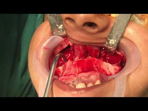 Cracking Down The Upper Jaw