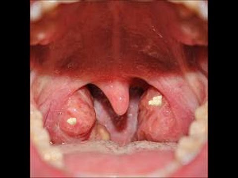 Schierling Behandlung von Prostatakrebs Behandlung von Patienten mit chronischer Prostatitis