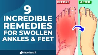 9 Incredible Remedies For Swollen Ankles and Feet
