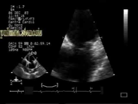 Zwężenie zastawki pnia płucnego: echokardiografia dwuwymiarowa z powiększeniem