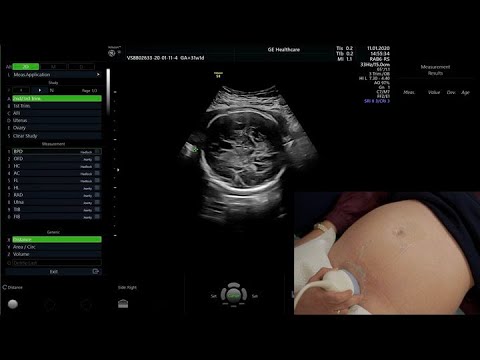 Badanie USG w III trymestrze ciąży zgodnie ze standardami PTG