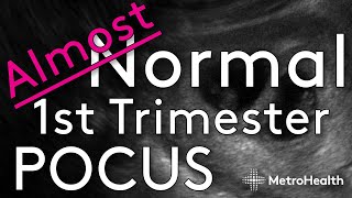 Not Quite Your Normal First Trimester Ultrasound