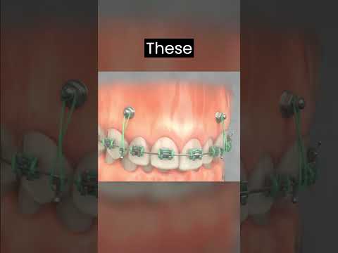 TADs 3 : The next level Orthodontic treatment technique