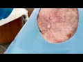Quick and Easy Whitehead Extraction by Dermatologist Dr. Timothy Jochen | CONTOUR DERMATOLOGY