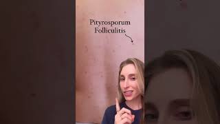 Should you use Head and Shoulders dandruff shampoo to treat acne? Dermatologist explains | #shorts