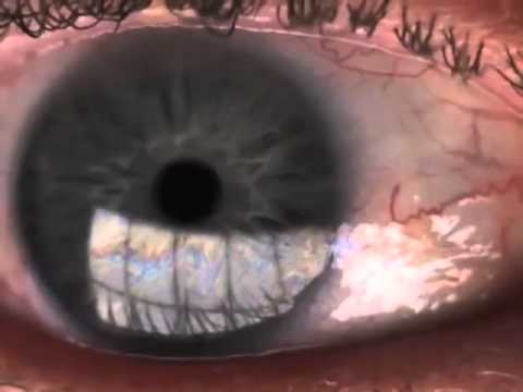 Dry Eye: LipiView