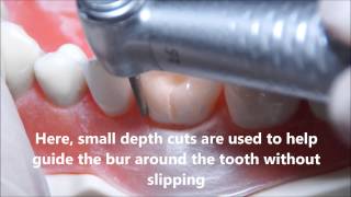 PFM Crown Preparation