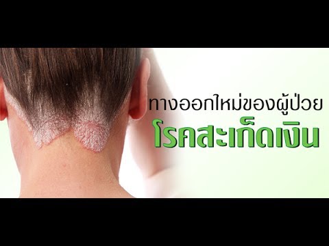 ความคิดเห็น Radevit สำหรับโรคสะเก็ดเงิน โรคสะเก็ดเงินจากสิ่งที่กำเริบ
